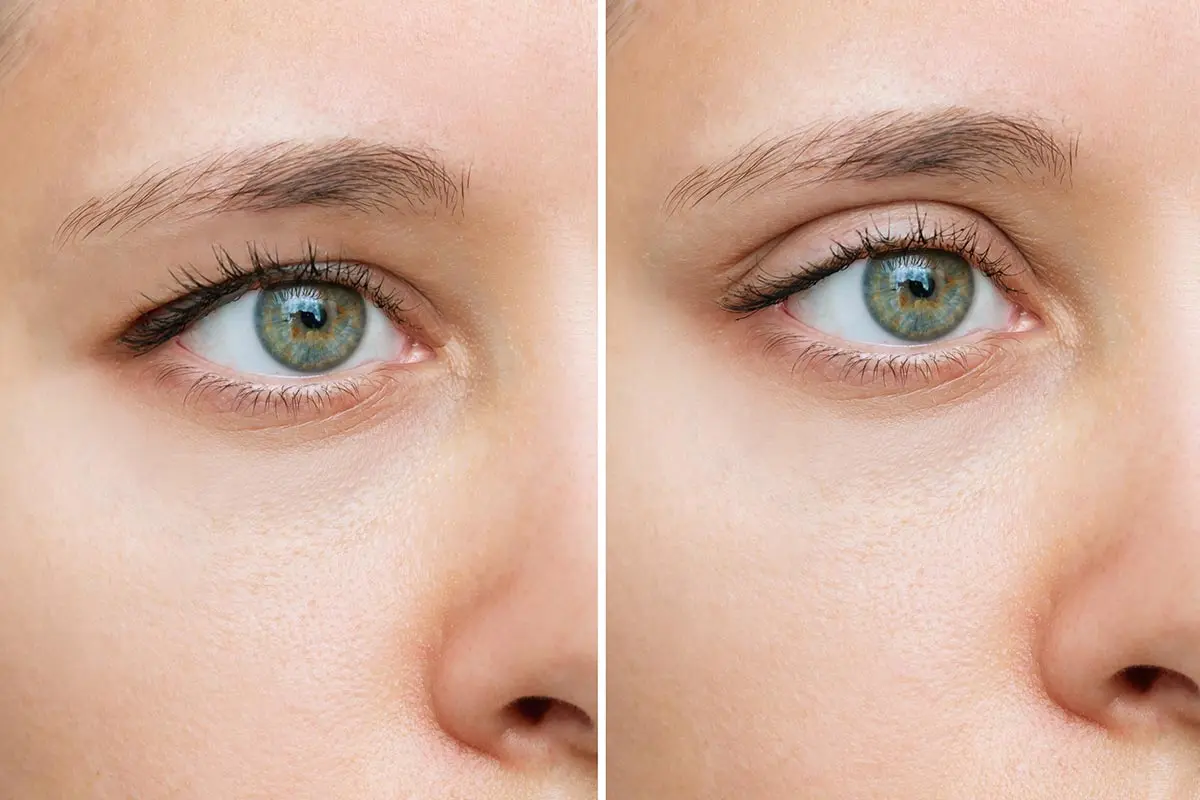 eye surgery cover