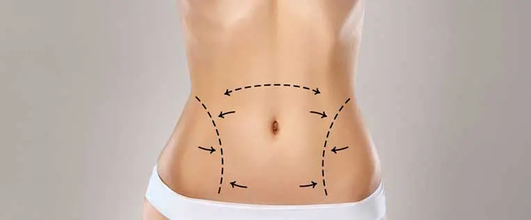 Things to consider Before Getting a Tummy Tuck
