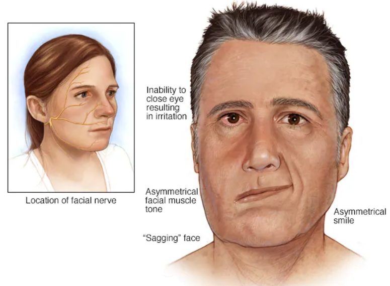 Causes and Treatment of Facial Paralysis