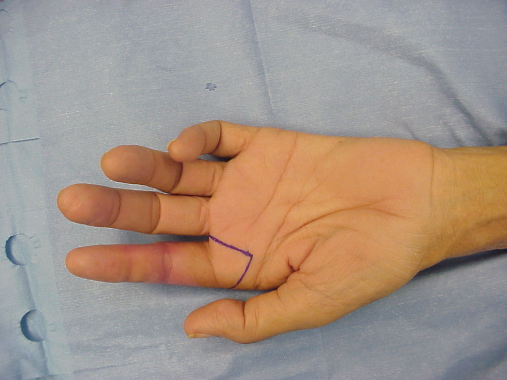 A transplanted index finger with blue marks under it