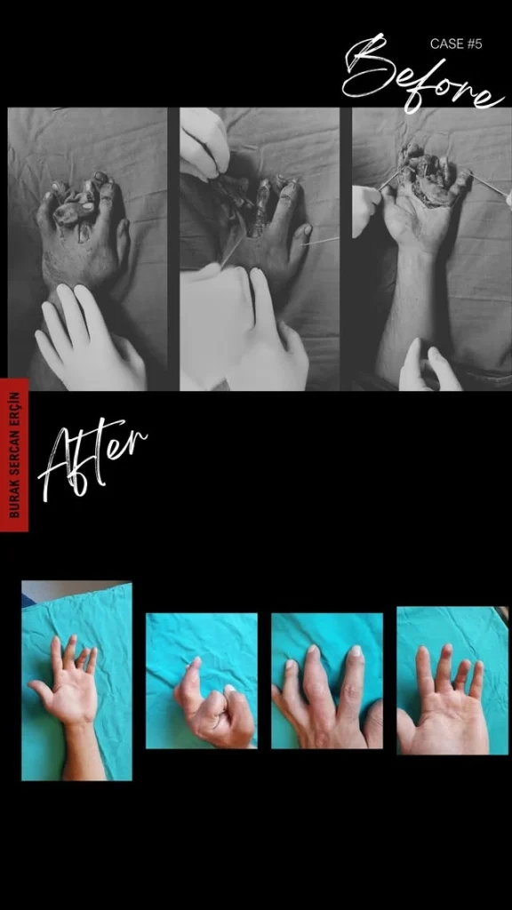finger transplant before after 1