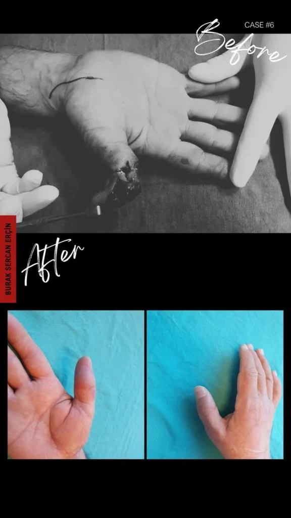 finger transplant before after 2