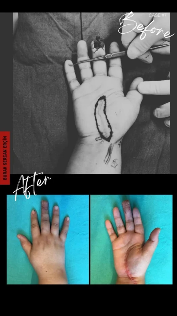 finger transplant before after 3