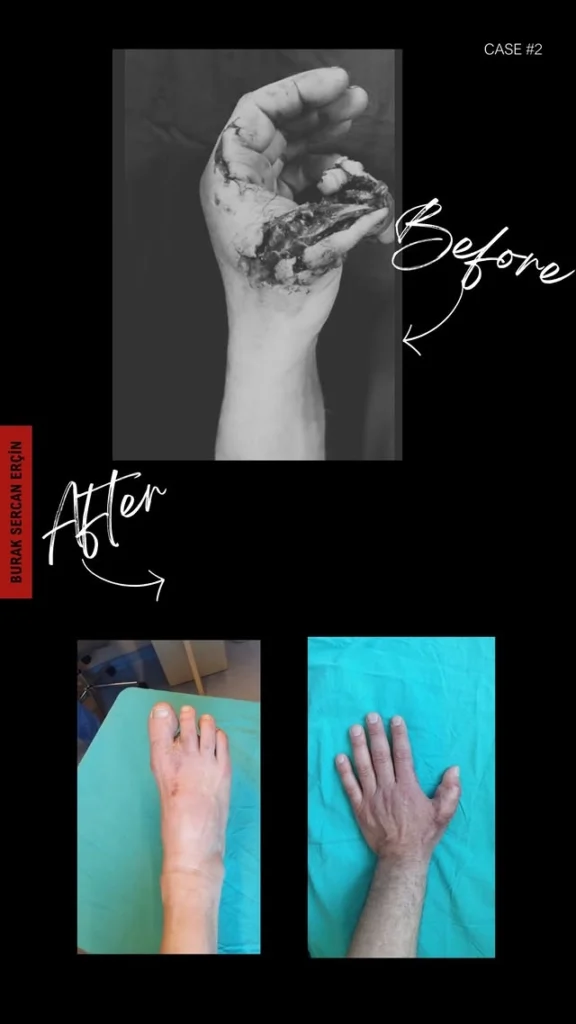 finger transplant before after 4
