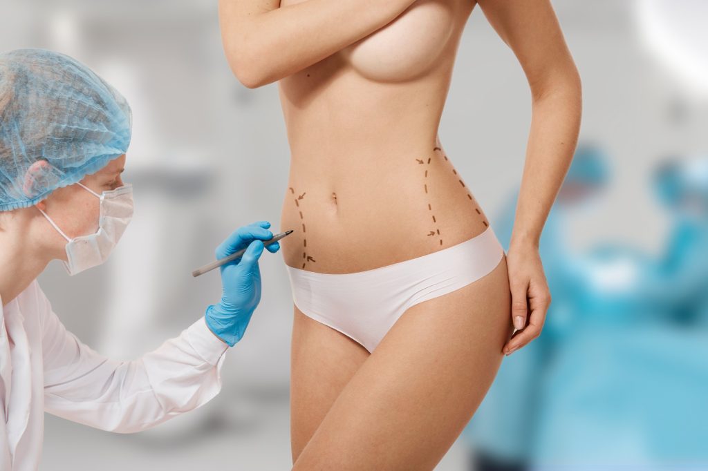 A woman after having her Tummy Tuck in Turkey