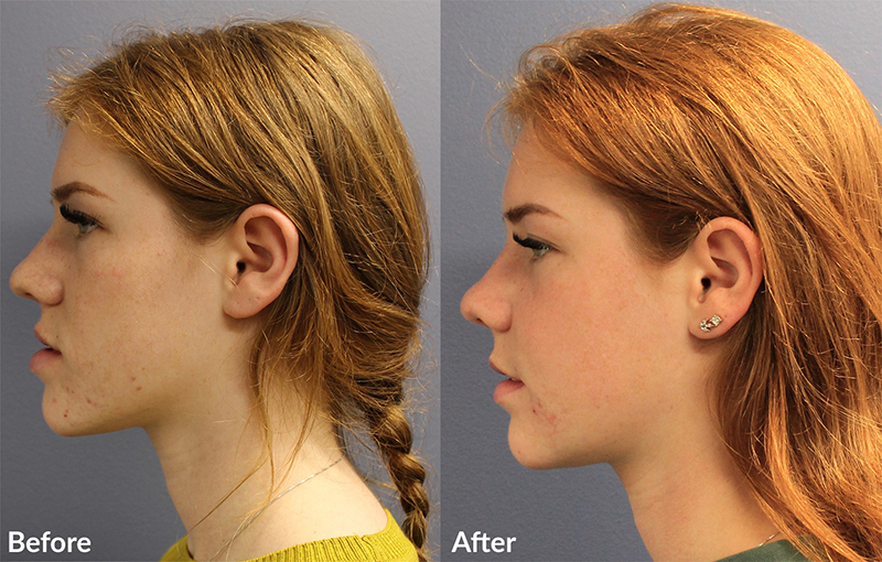 A patient before and after her jaw surgery for overbite