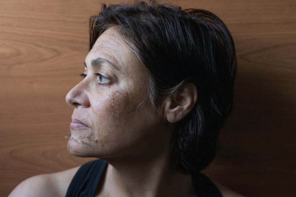woman with facial burn scars before surgery