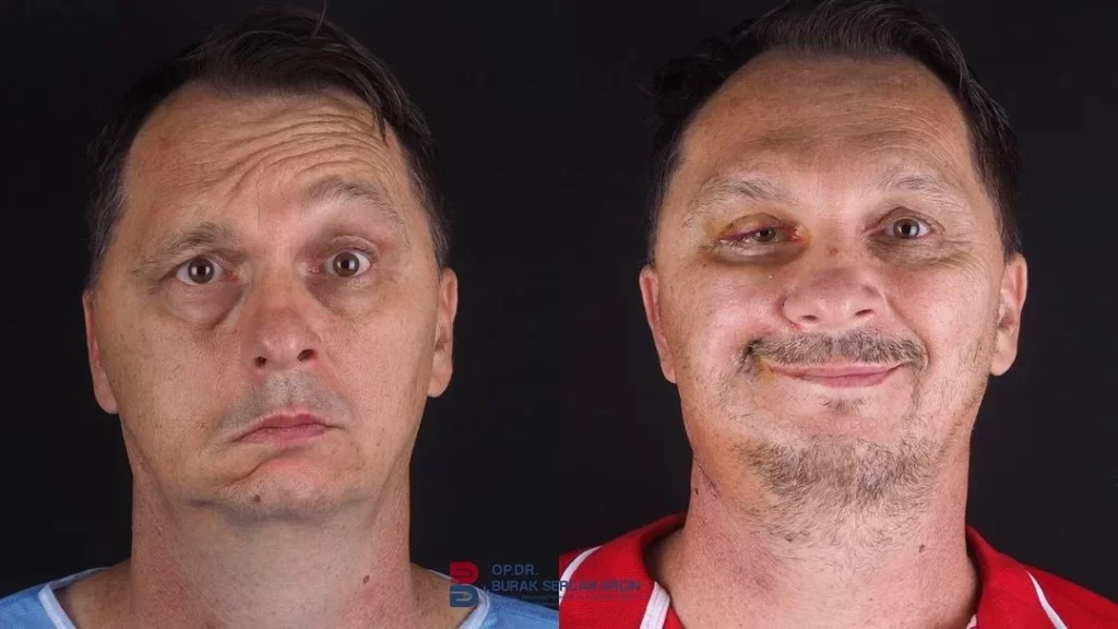 Before After of bells palsy treatment