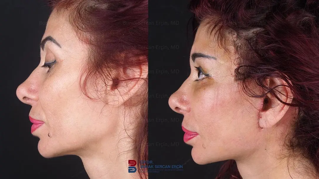 jaw-surgery-in-turkey-before-after