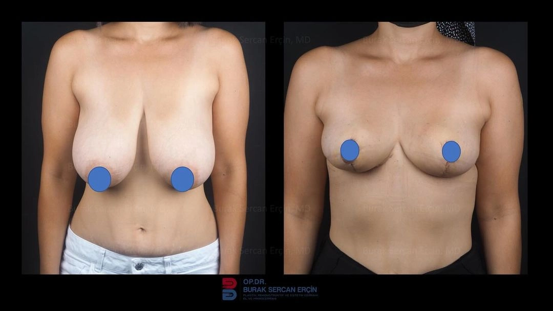 Breast Surgery