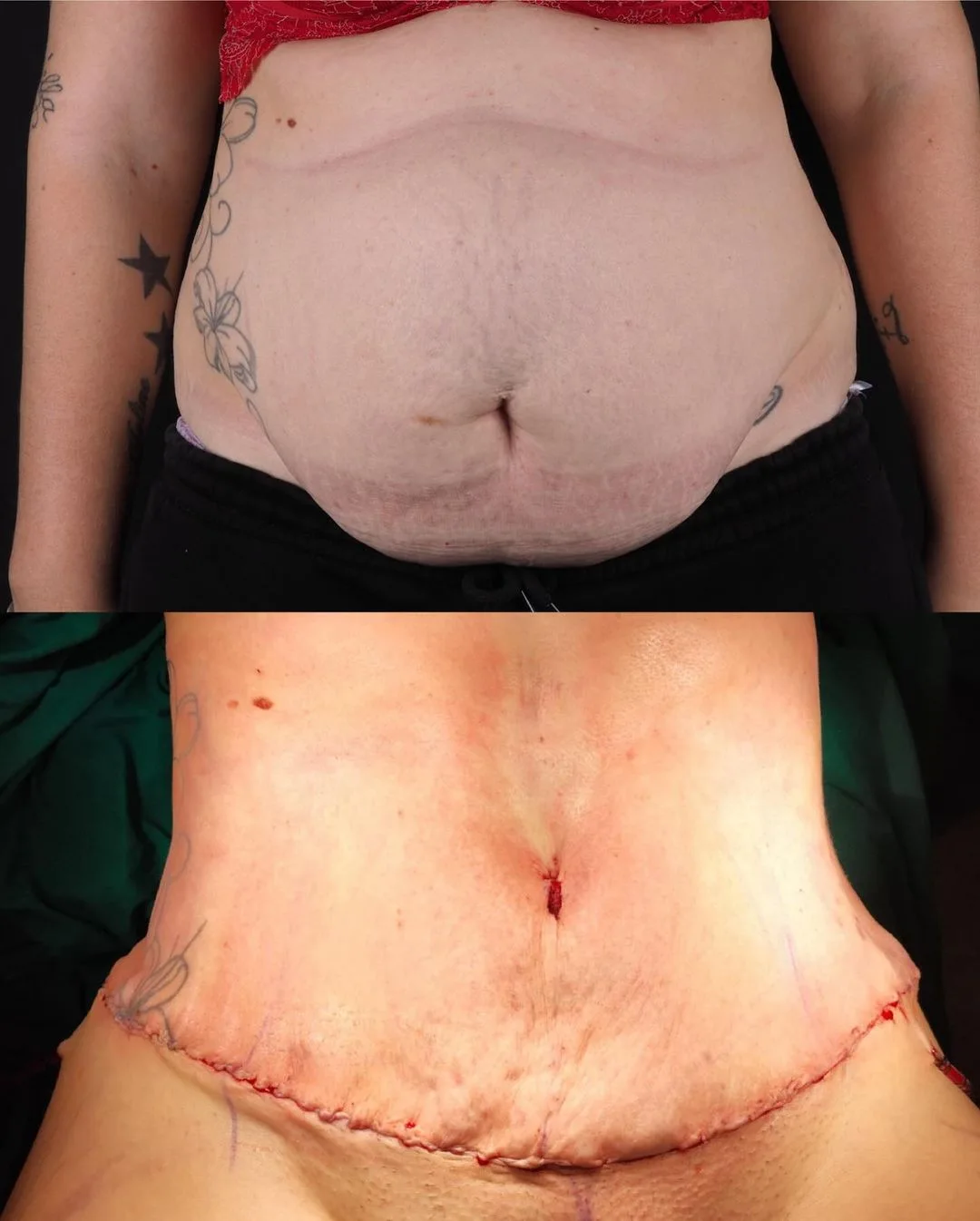 Tummy Tuck