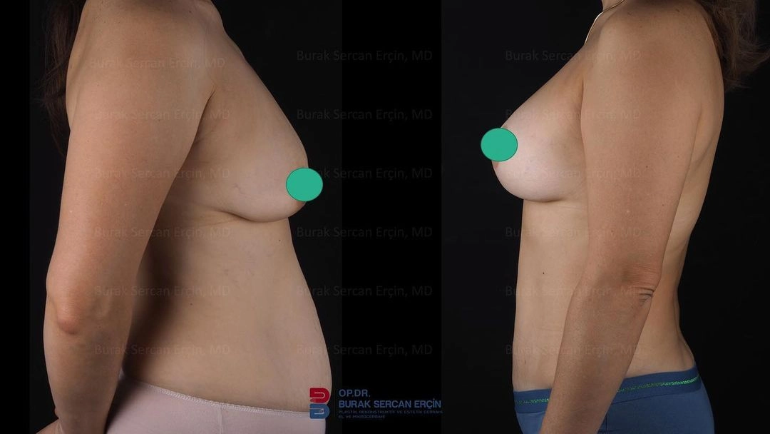 lifted-breast-changed-burak