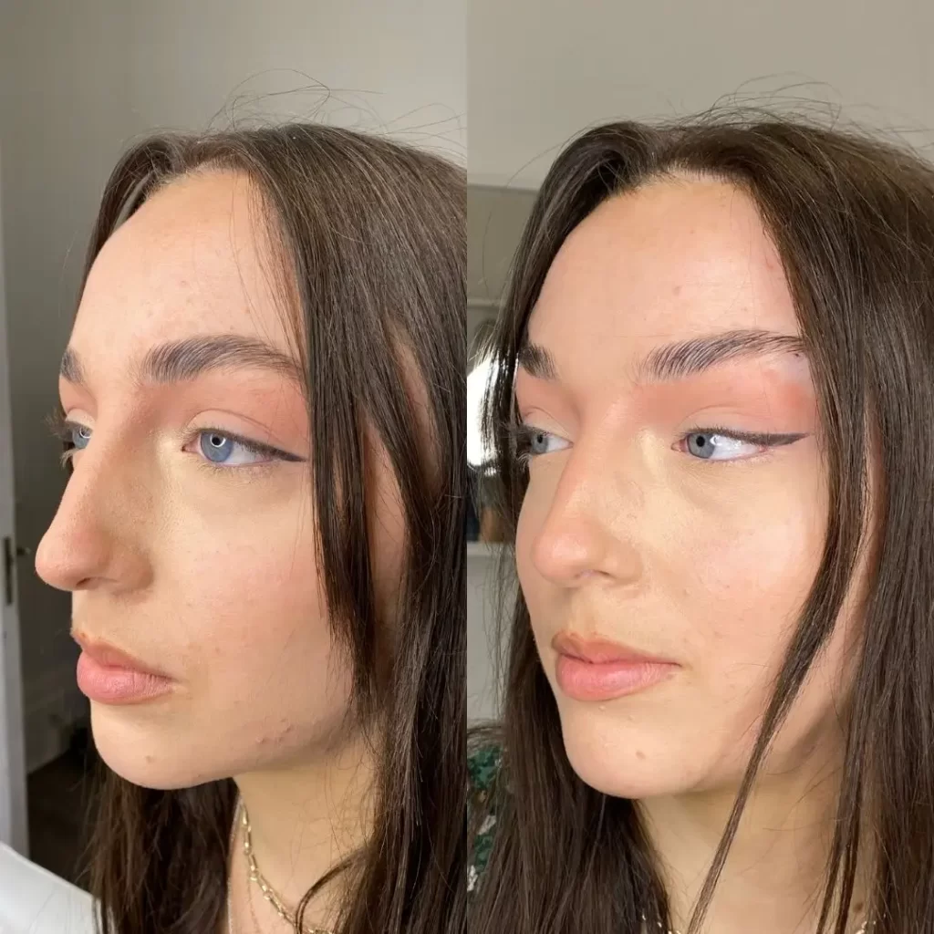 Fox-Eyes-Lift