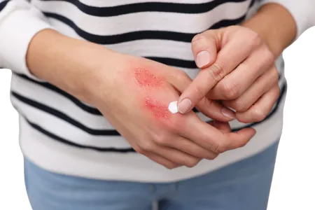 Burn Body