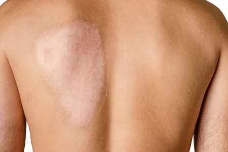 Burn Body