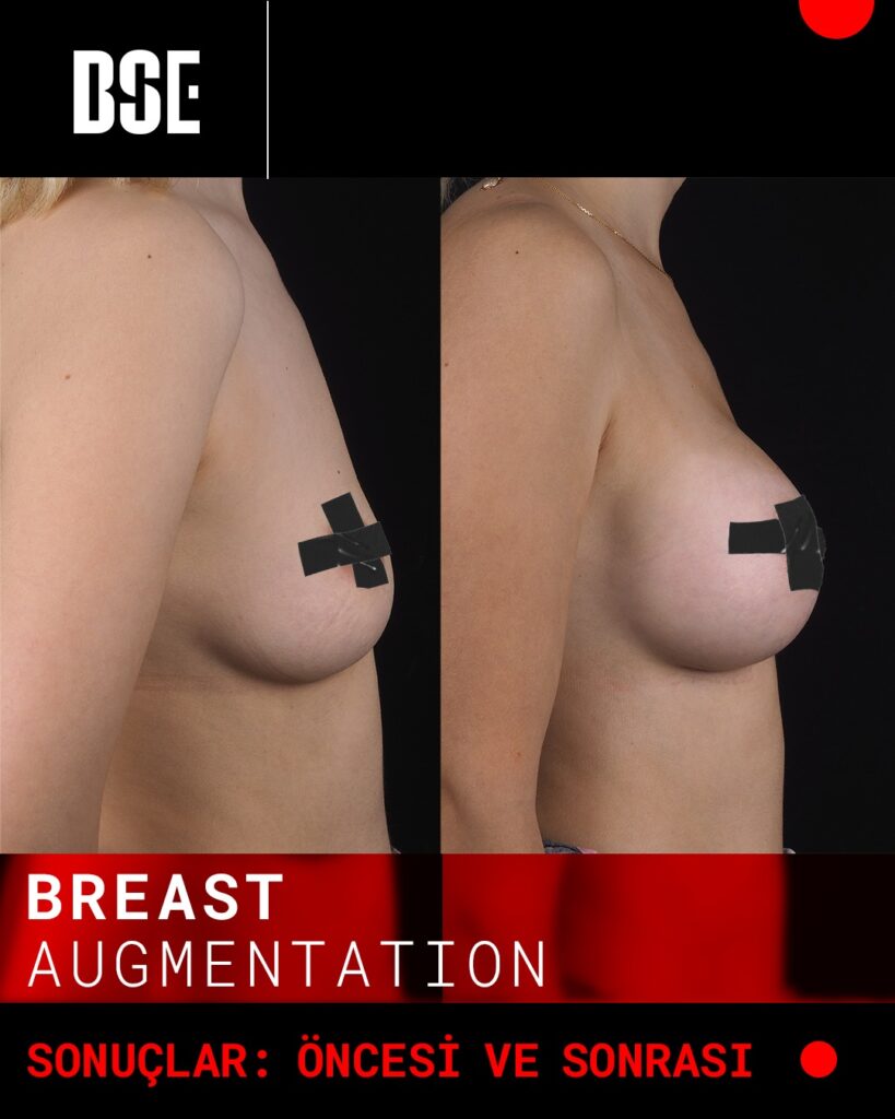boob lift profile