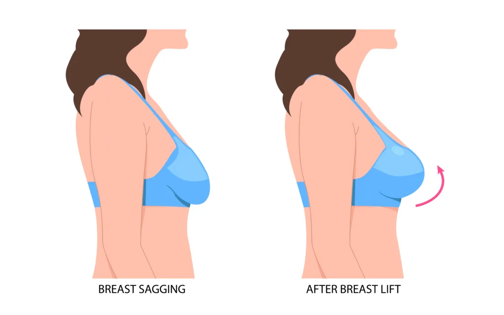 breast fat lift model