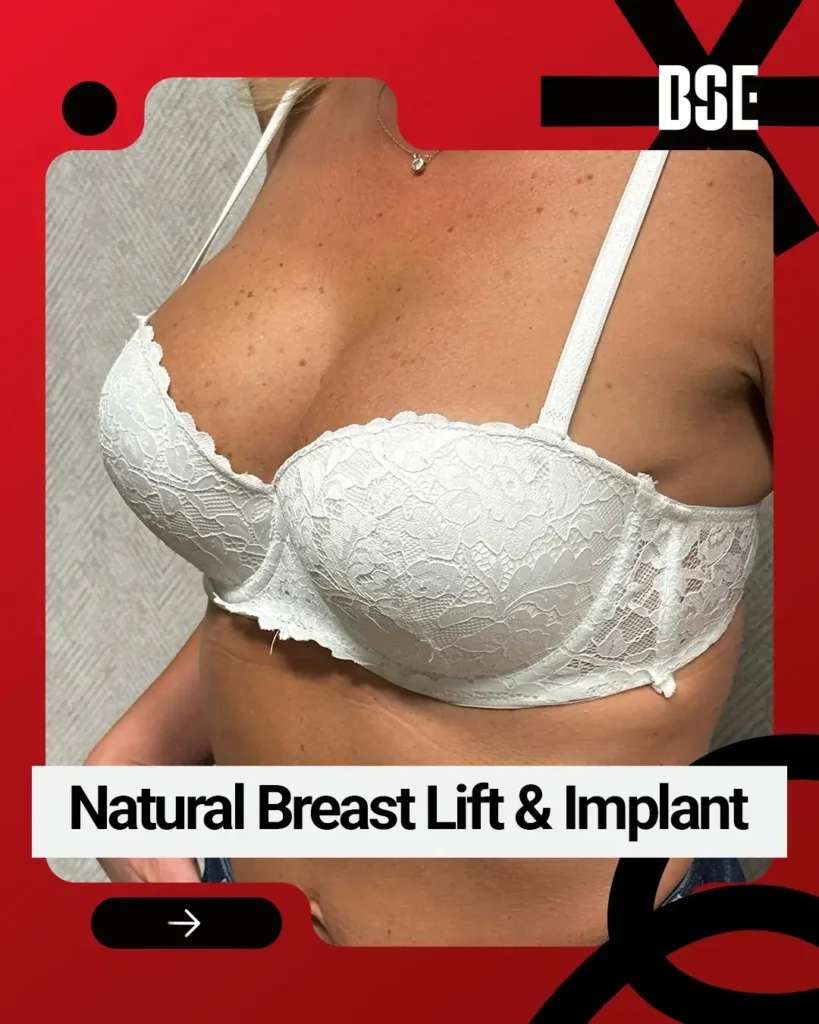 breast lift gallery 2