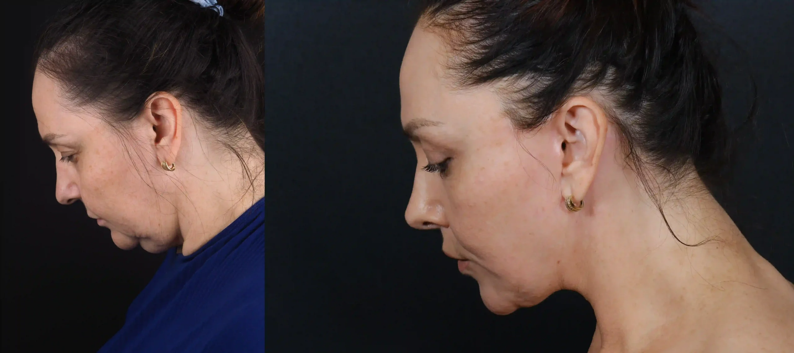 before after facelift 