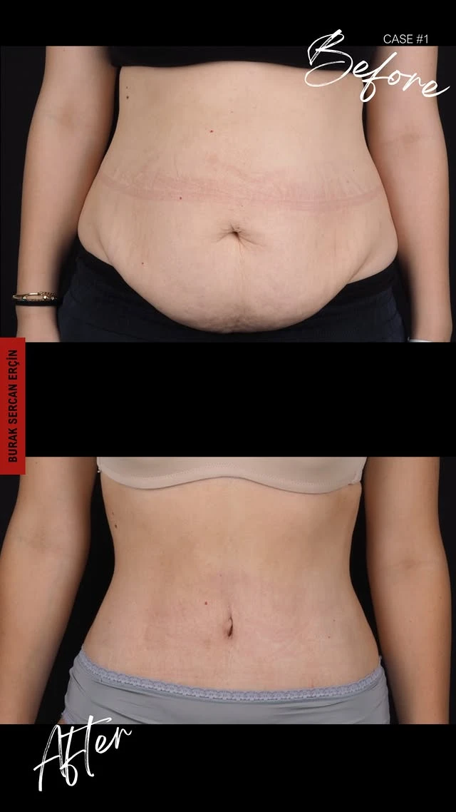 Tummy Tuck Lipo Before After 1