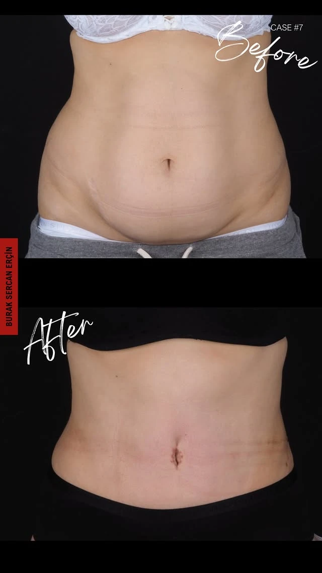 Tummy Tuck Lipo Before After 10 Tummy Tuck Lipo Before After 10