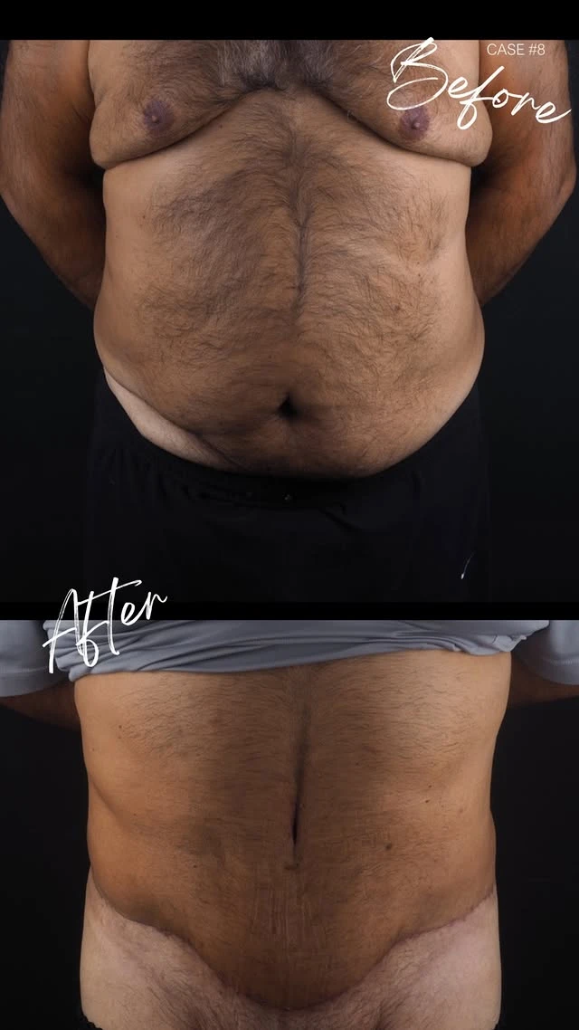 Tummy Tuck Lipo Before After 13