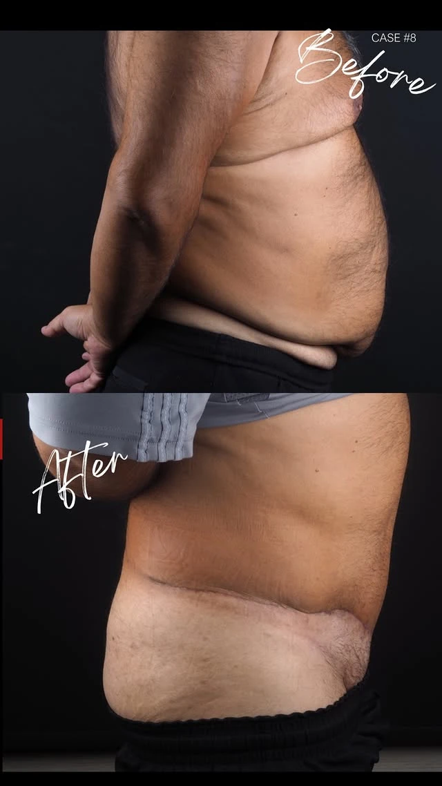 Tummy Tuck Lipo Before After 14 Tummy Tuck Lipo Before After 14