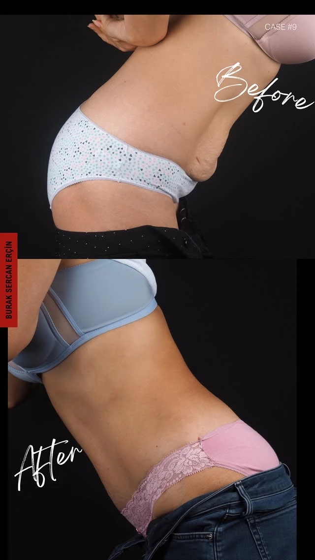 Tummy Tuck Lipo Before After 15 Tummy Tuck Lipo Before After 15