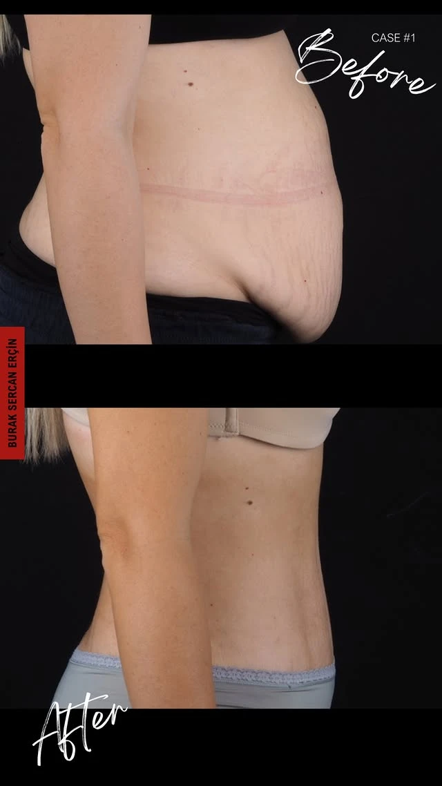 Tummy Tuck Lipo Before After 2