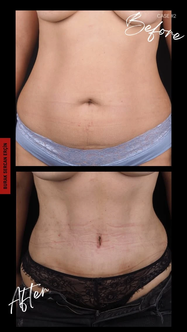 Tummy Tuck Lipo Before After 3