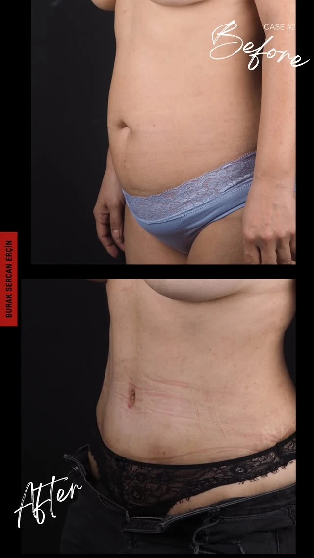 Tummy Tuck Lipo Before After 4
