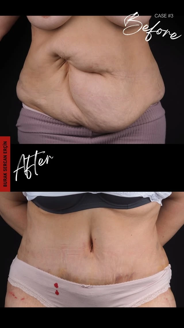 Tummy Tuck Lipo Before After 5