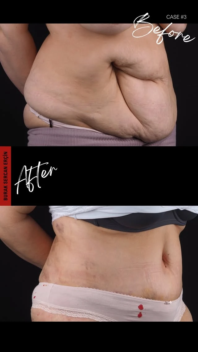 Tummy Tuck Lipo Before After 6