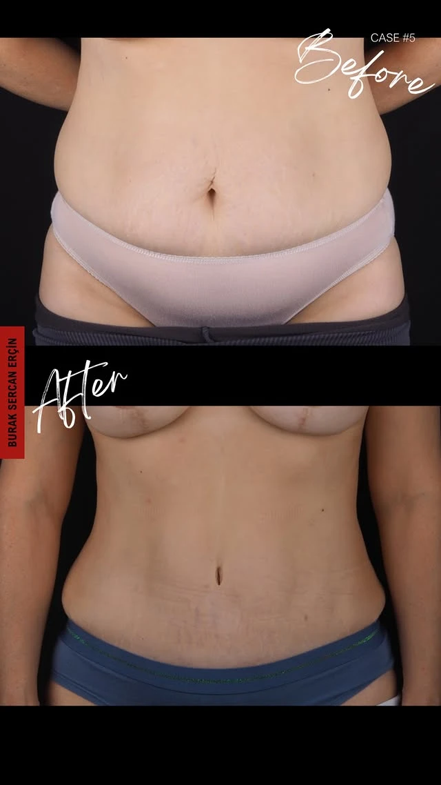 Tummy Tuck Lipo Before After 7