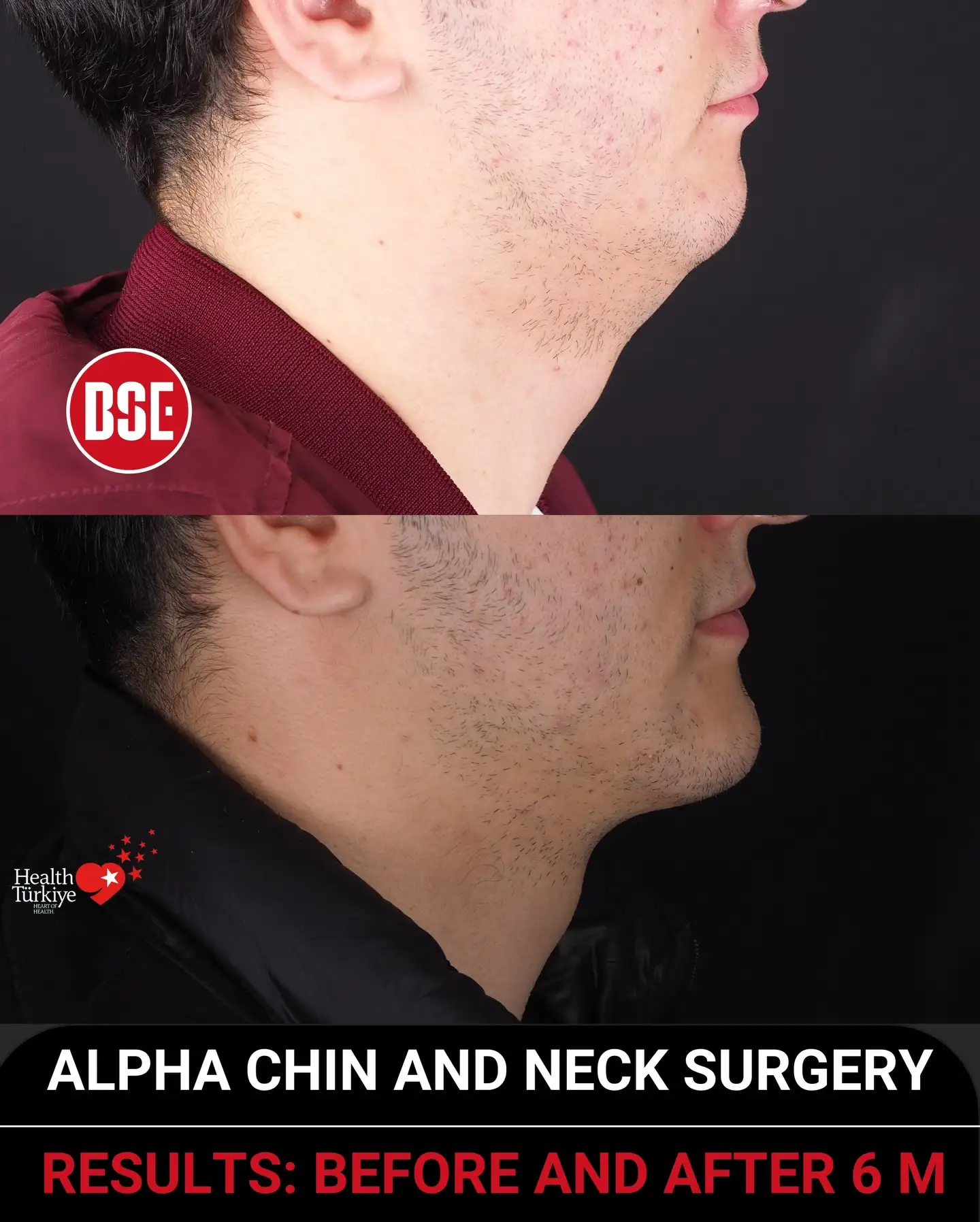 alpha chin before after