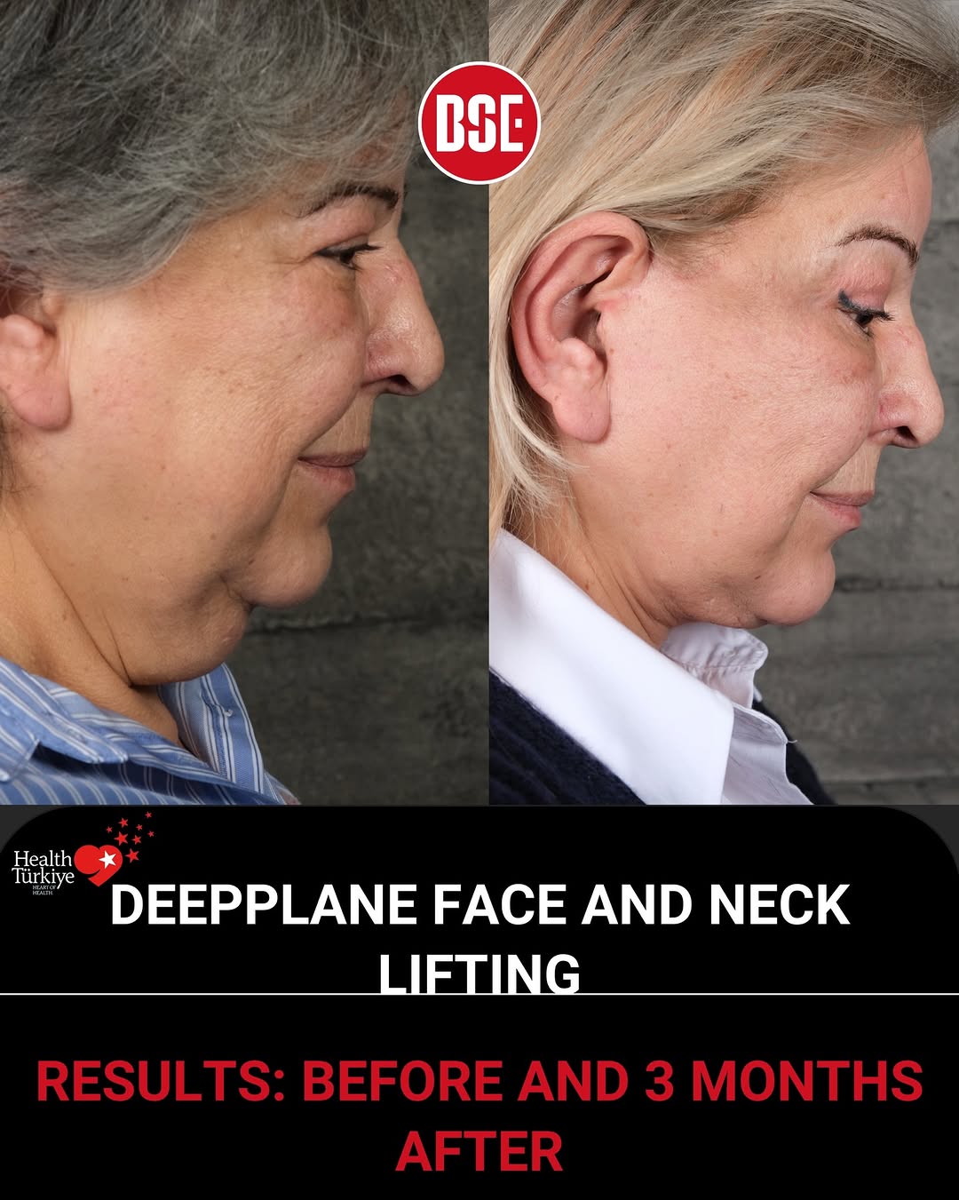 deeplane facelift lady before after
