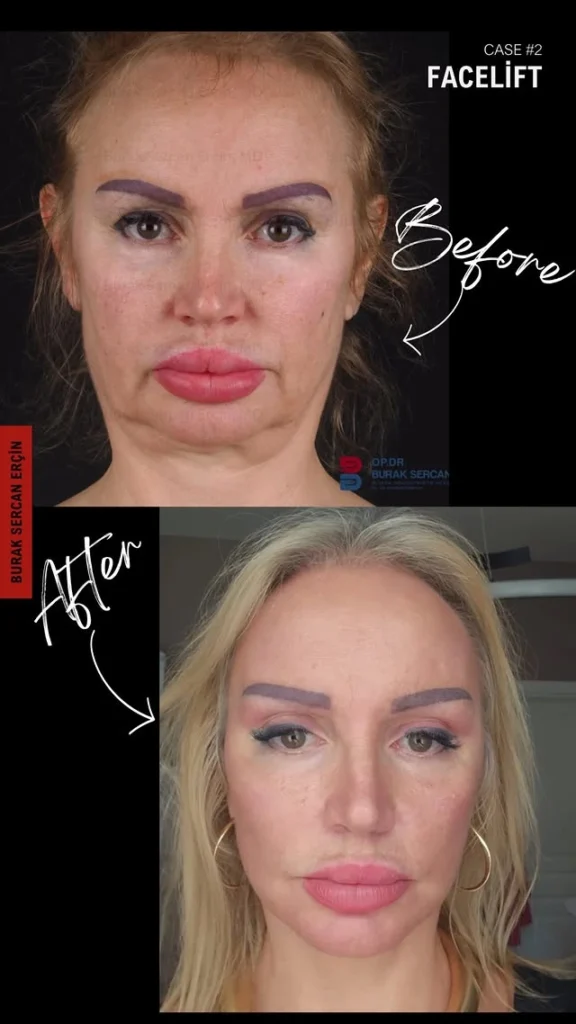 facelift before after blonde