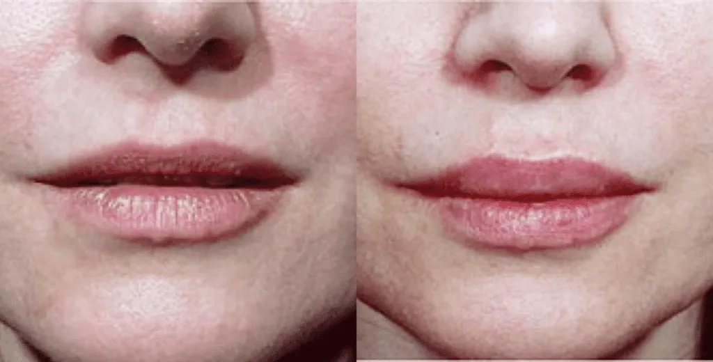 scarless liplift