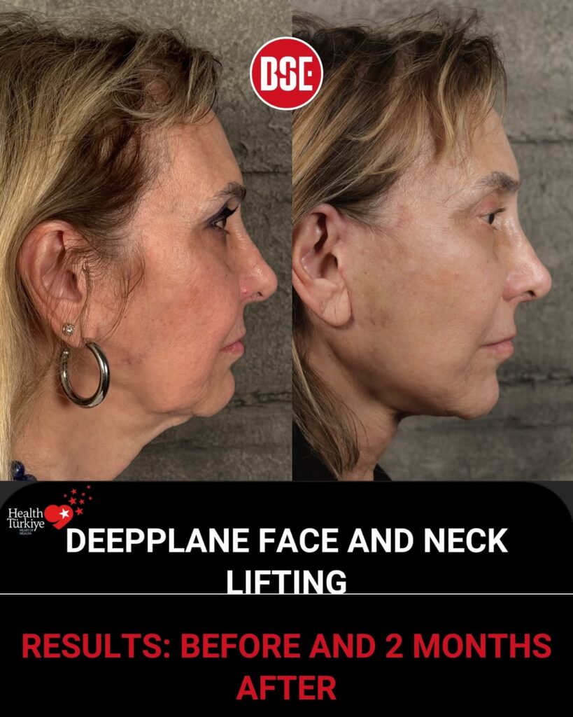 2 months after deep plane facelift and neck lift.