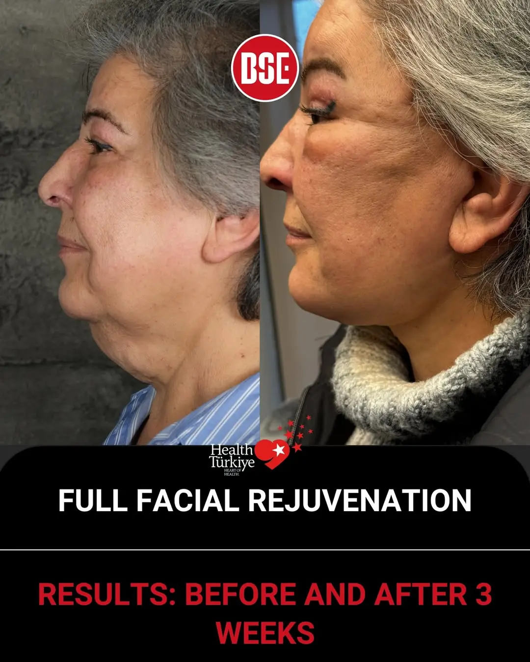 Full Facial Rejuvenation - 3 Weeks Post-OpA heavy face is never an easy face.
