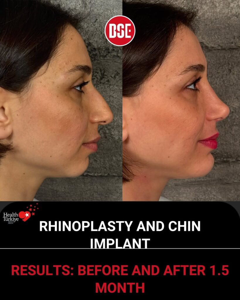 Nose before after profile