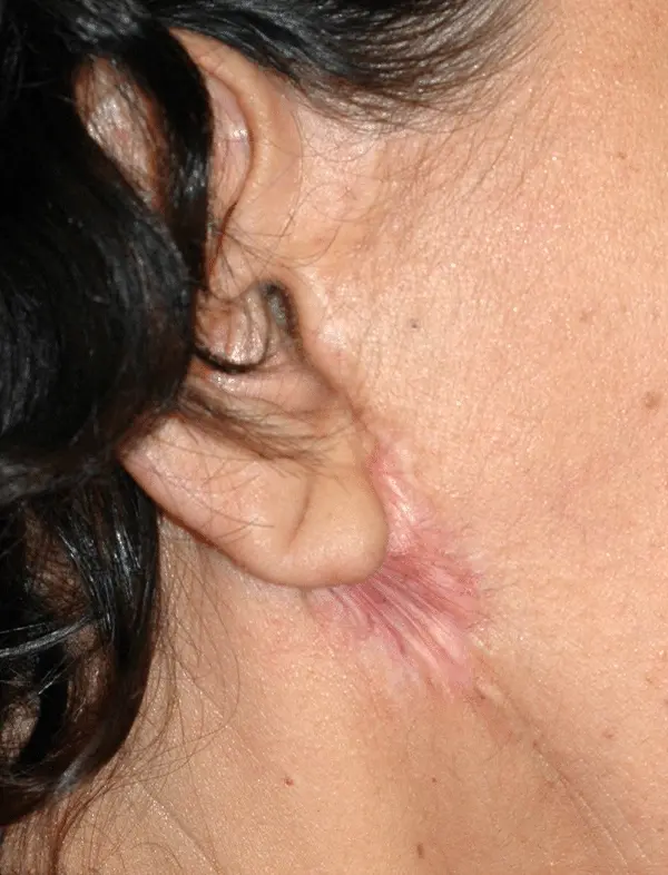 facelift-scars-turkey
