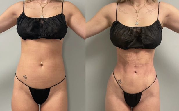 rib-remodeling