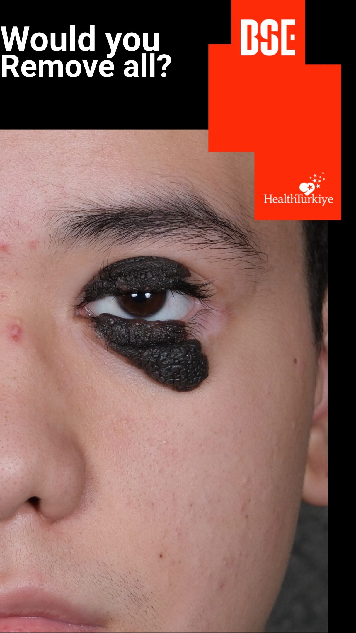 nexus surgery eyelid