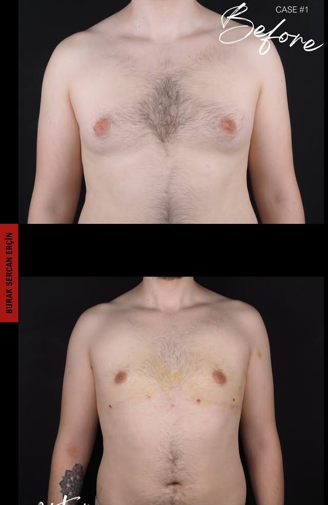 gyno 2 2 months after deep plane facelift and neck lift.
