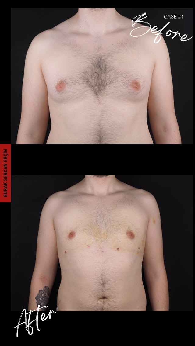 Gynecomastia surgery before and after, case 1