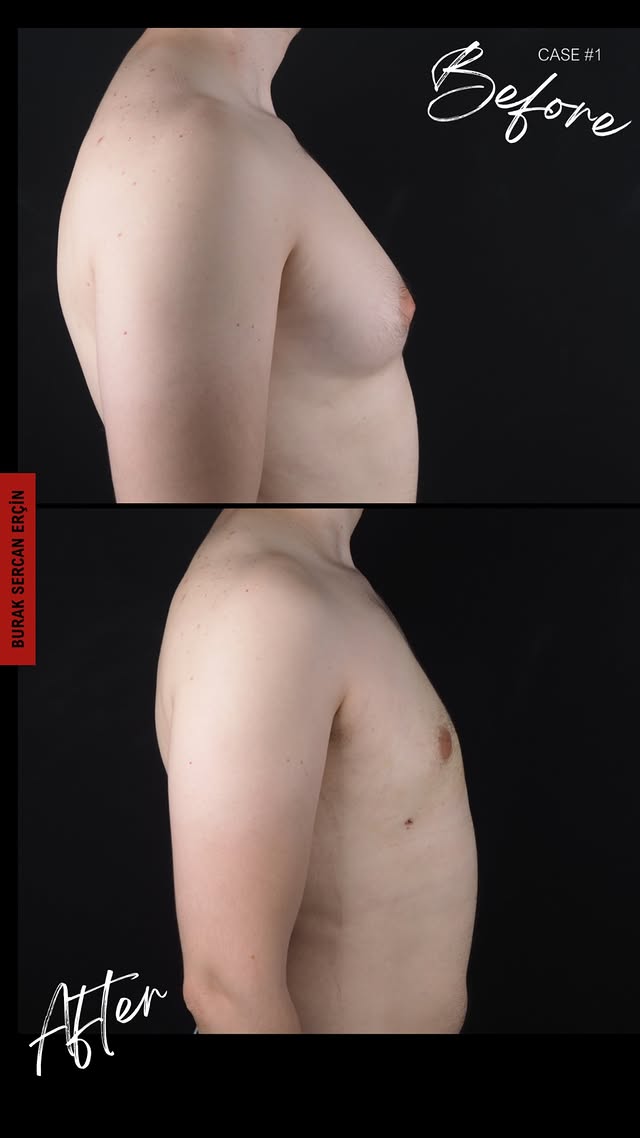 Gynecomastia surgery before and after, case 2