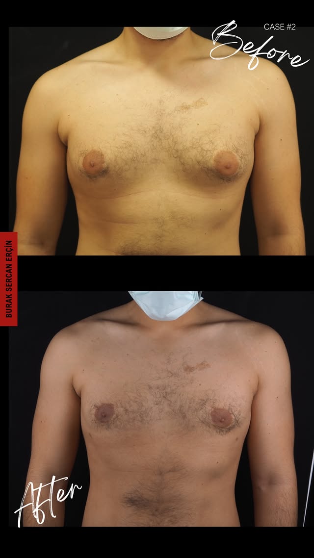 Gynecomastia surgery before and after, case 4