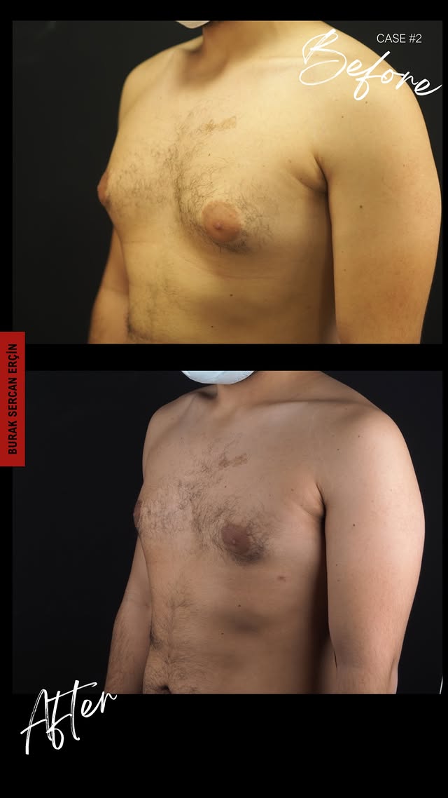 Gynecomastia surgery before and after, case 5