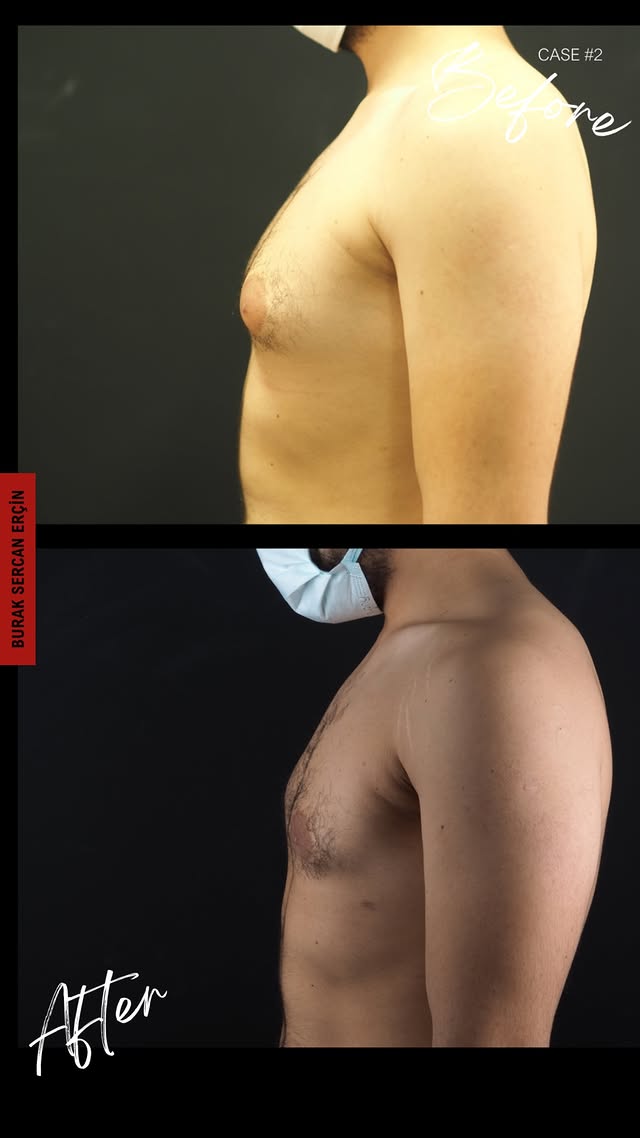 Gynecomastia surgery before and after, case 6